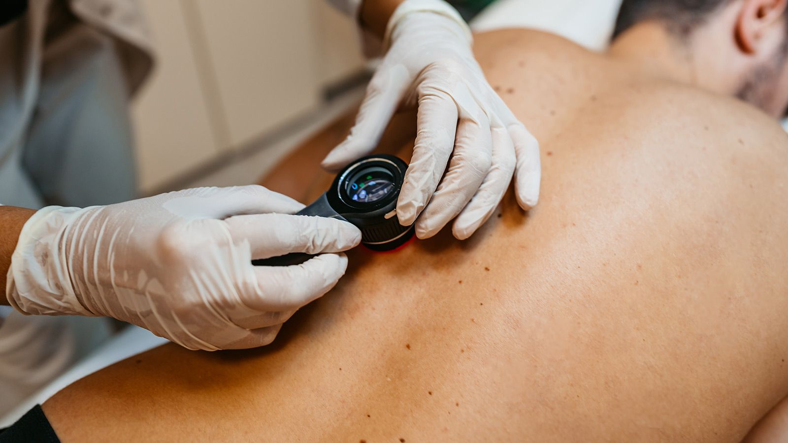 Kvinde­lig læge undersøger en patients modermærker for hudkræft på en klinik.
