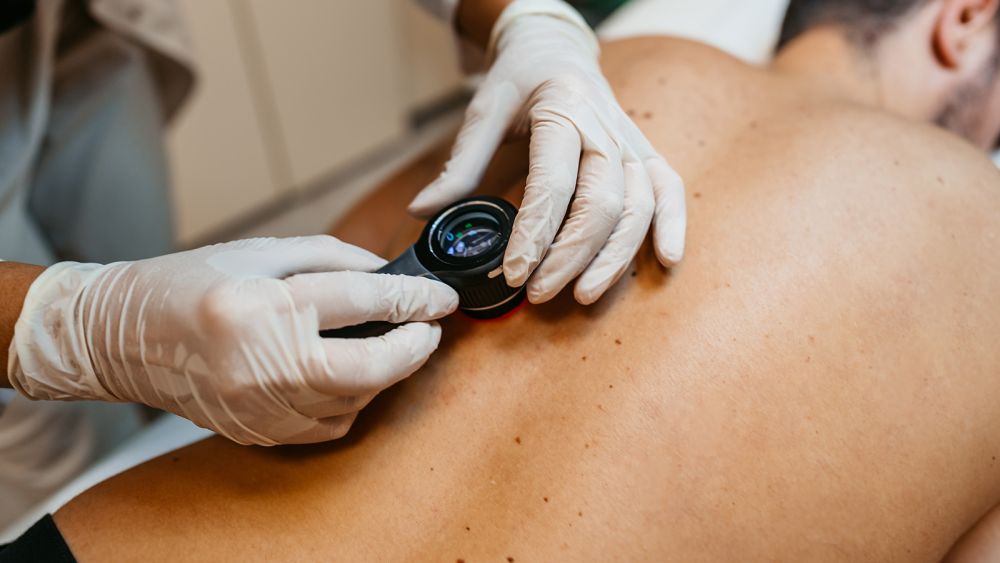 Kvinde­lig læge undersøger en patients modermærker for hudkræft på en klinik.